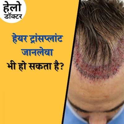 हेयर ट्रांसप्लांट करवाने के बारे में सोच रहे हैं तो ये ज़रूर सुनिए : हेलो डॉक्टर, Ep 110