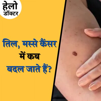 तिल,मस्सा अगर रंग आकार बदले तो क्यों जाएं डॉक्टर के पास?: हेलो डॉक्टर, Ep 177