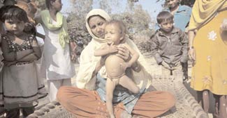 कुपोषित बच्चे