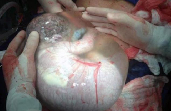 newborn delivered inside amniotic sac