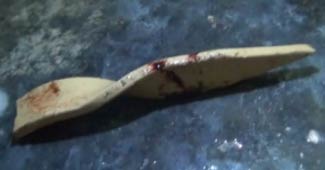 ऑपरेशन के बाद बच्चे के मुंह से निकाला सरिया