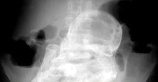 महिला के पेट में 40 साल का भ्रूण पल रहा है