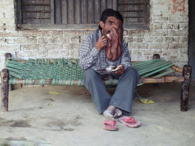 चना लाल के इस सूंडनुमा ट्यूमरका वजर चार किलो है