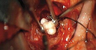 ब्रेन ट्यूमर से दांत निकाला, फोटो: आईएएनएस