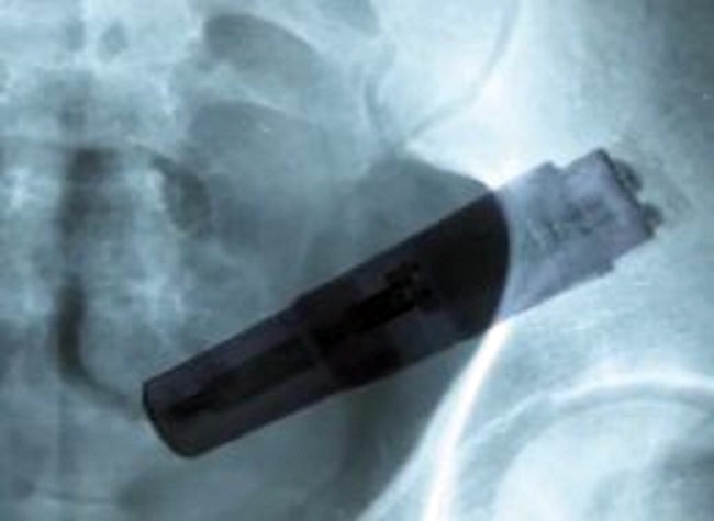 आंत में फंसे वाइब्रेटर का एक्‍सरे