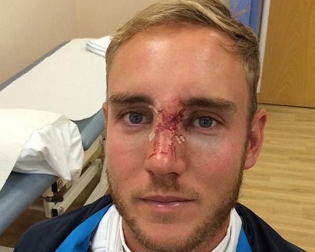 ब्रॉड ने चोट की इमेज ट्वीटर पर अपलोड की