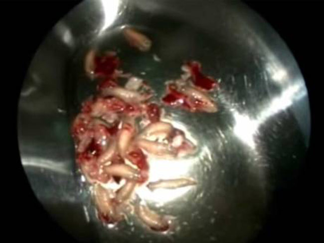 नाक से निकाले गए बदबूदार कीड़े