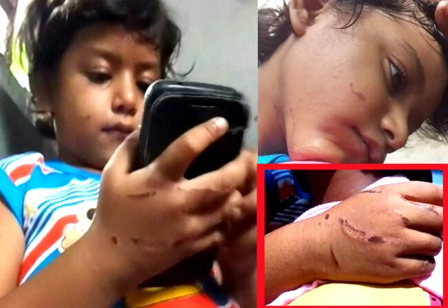 पीड़ित मासूम, जिसे सिगरेट से दागा गया.