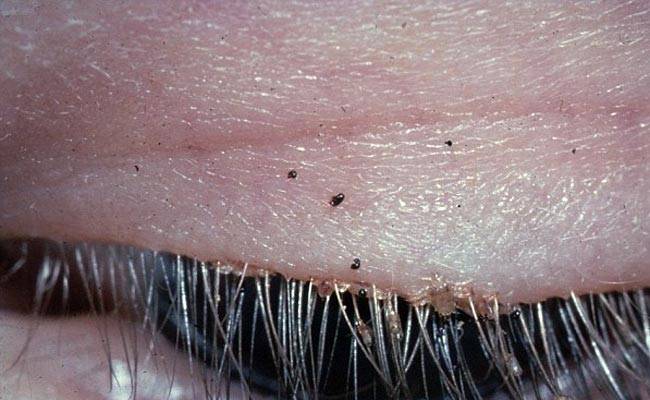 20 lice in woman's eyelash
