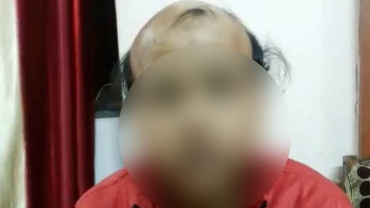 सिर पर बाल नहीं होने की वजह से नहीं दिया एडमिशन