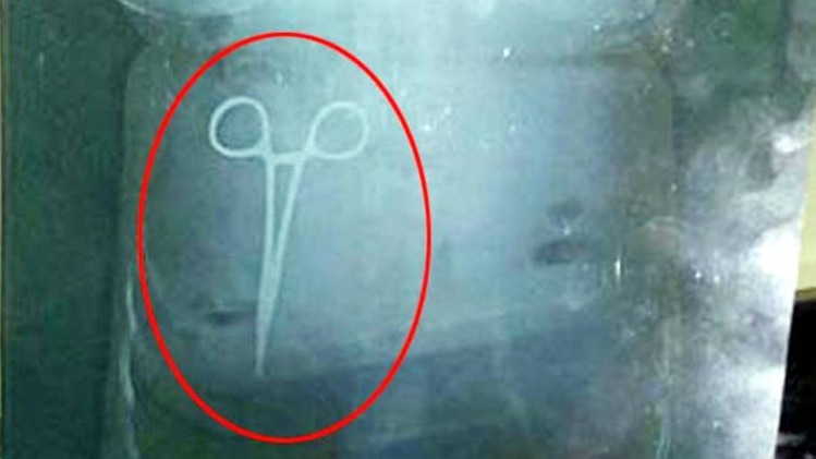 पांच साल बाद महिला के पेट में मिली कैंची