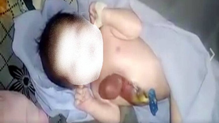 एक्टोपिया कॉर्डिस नाम की दुर्लभ बीमारी की शिकार है बच्ची 