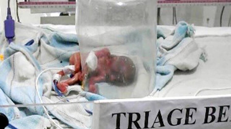 जिंदा बच्ची को मृत घोषिक किया 