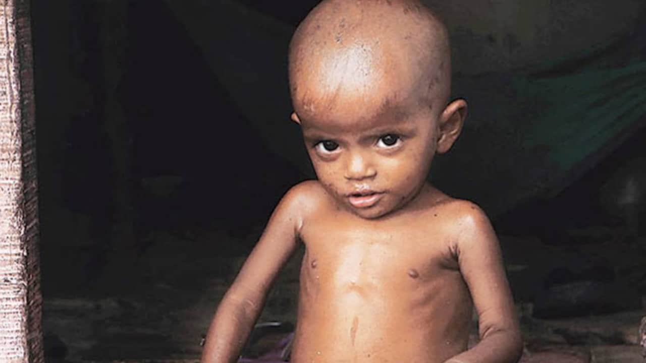गुजरात में गांव-गांव में फैला है कुपोषण का 'दानव', लगातार जान गंवा रहे हैं नौनिहाल - gujarat reality check of malnutrition issue in children women by india today - AajTak