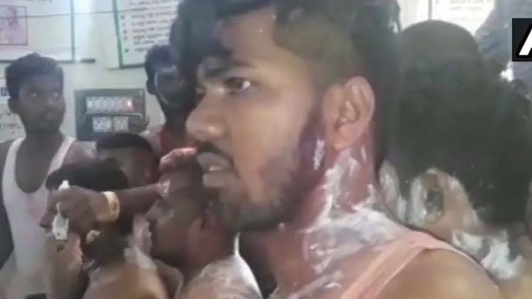 एसिड अटैक में घायल कांग्रेस कार्यकर्ता, (फोटो-एएनआई)