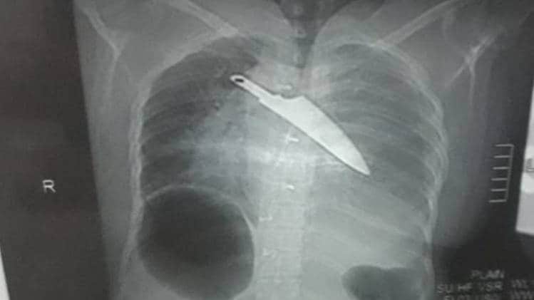 सर्जरी के बाद निकला चाकू (Photo- Aajtak)