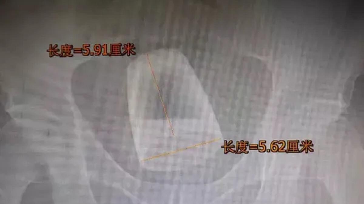 डॉक्टर्स की टीम ने सर्जरी करके निकाला गिलास