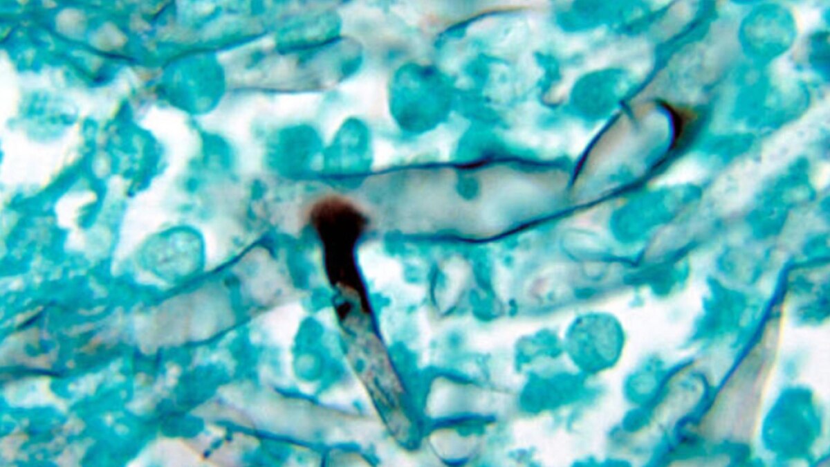 एक ही मरीज में ब्लैक-व्हाइट फंगस ( सांकेतिक फोटो)