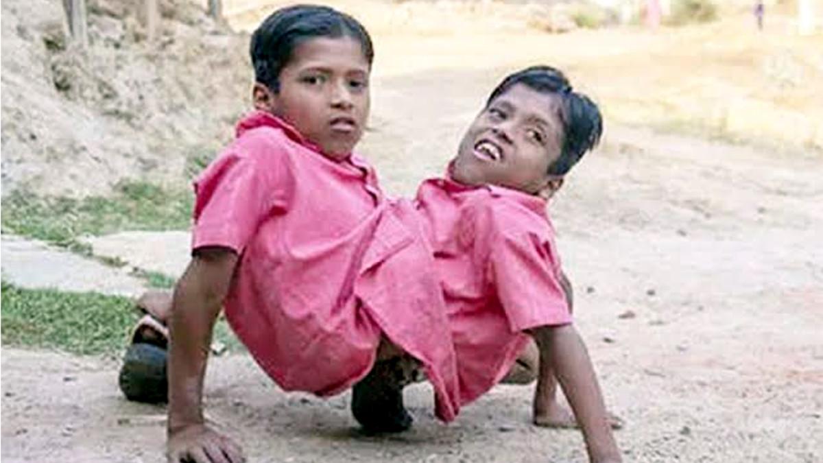 धड़ से जुड़े जुड़वां भाईयों की मौत.