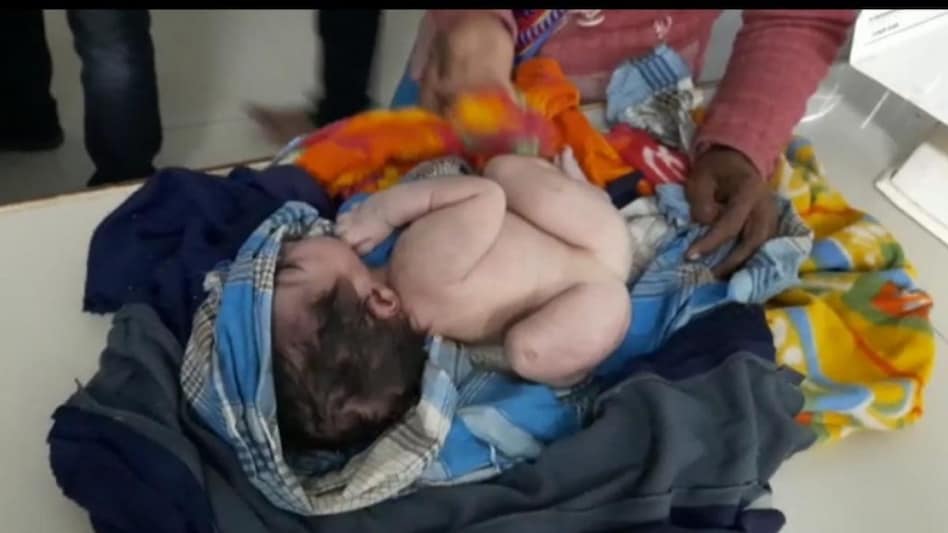 बच्चे के तीन पैर और तीन हाथ हैं