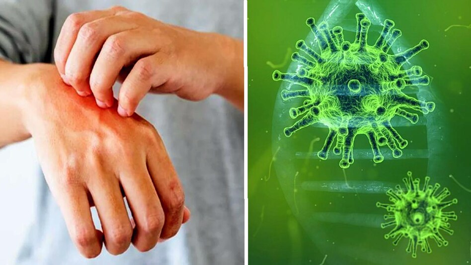 Omicron symptom: ओमिक्रॉन की निशानी हैं त्वचा पर दिखने वाले ये लक्षण! ना करें नजरअंदाज, तुरंत दें ध्यान - Omicron warning symptoms skin rashes that can show on your skin Hives Prickly