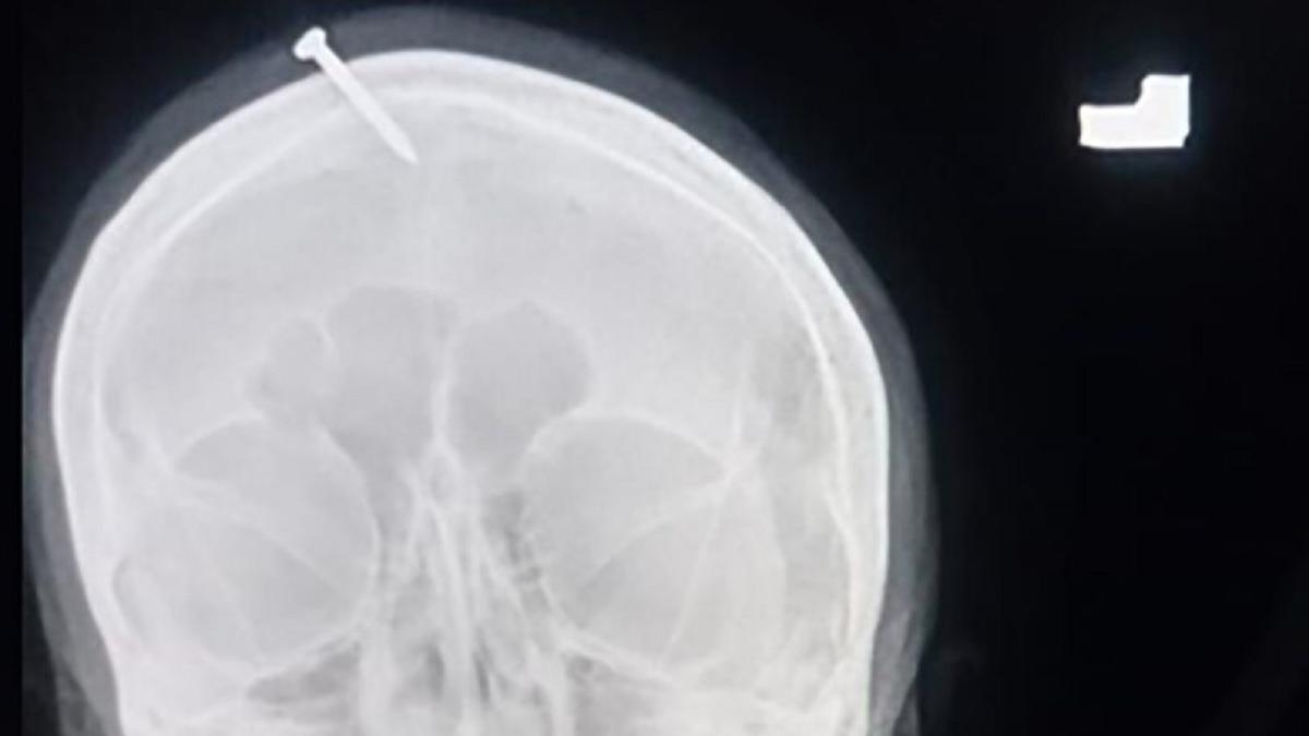 महिला के सिर का एक्‍स-रे 