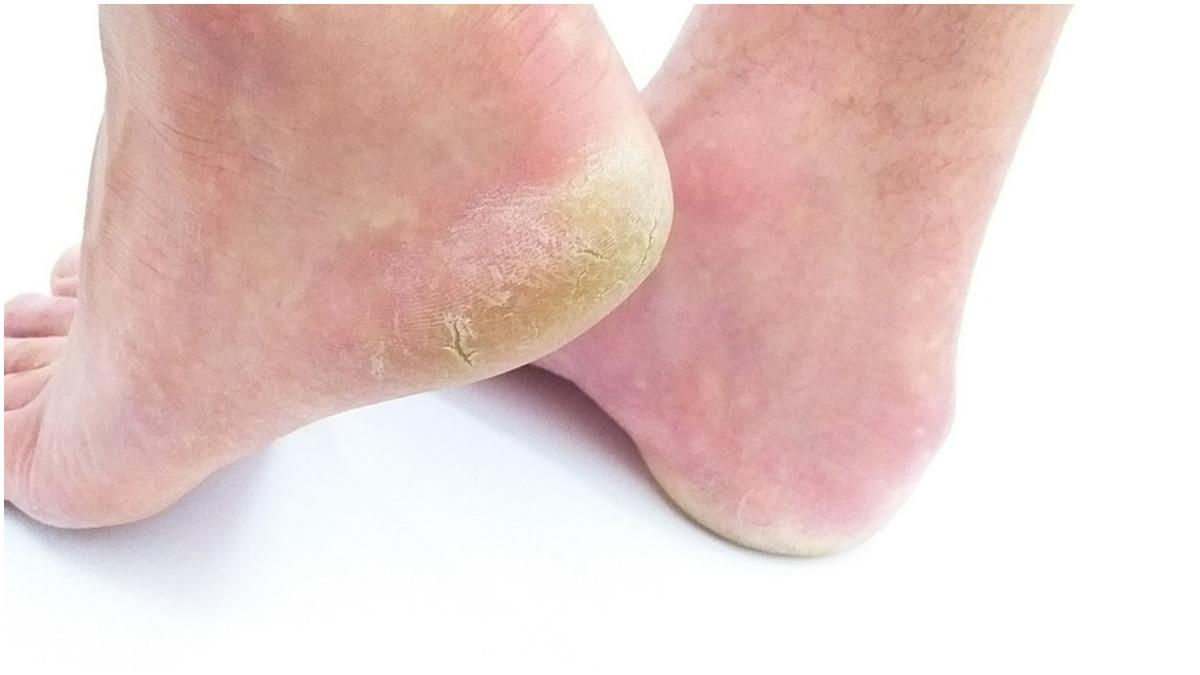 सालभर रहते हैं फटी एडियों की समस्या से परेशान? इन विटामिन्स की कमी हो सकती है वजह (Photo Credit: Pixabay)