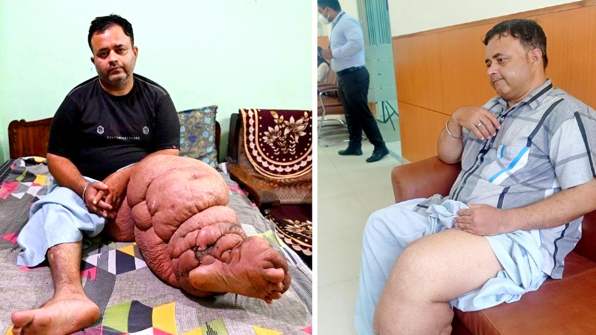 अमित कुमार को एक्सीडेंट के बाद यह बीमारी हो गई थी.