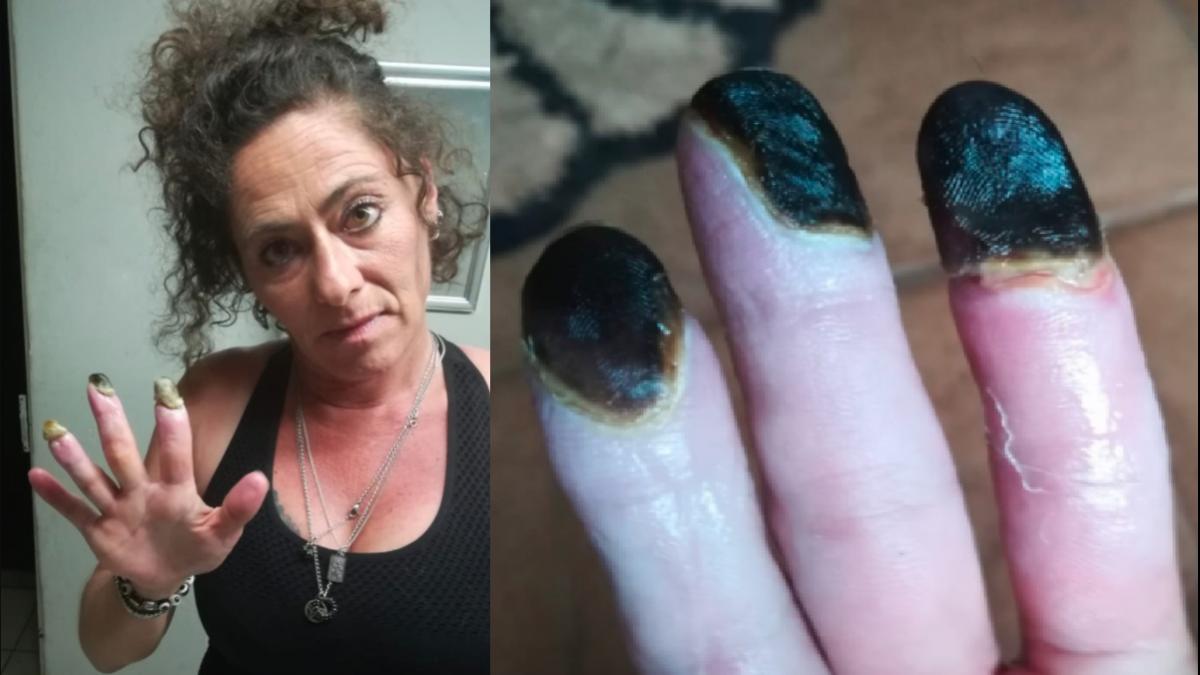 सिगरेट पीने की वजह से उंगलियां झड़ीं (Courtesy- Melinda Jansen van Vuuren)