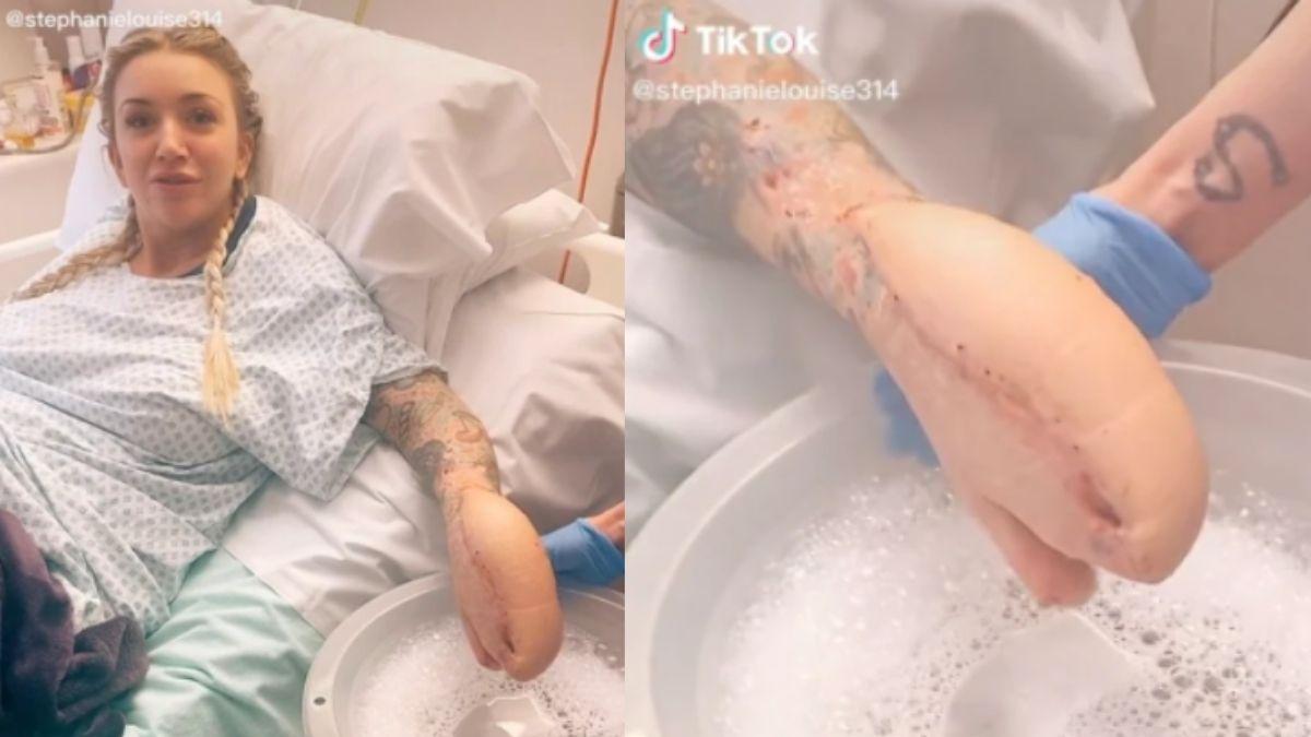 शार्क मछली की मुंह की तरह हो गया महिला का हाथ (Credit- Sadie Kemp)