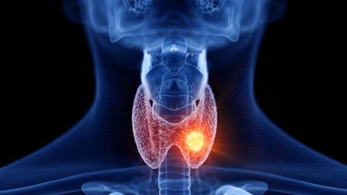 थायराइड का संकेत देते हैं कुछ लक्षण (Photo: gettyimages)
