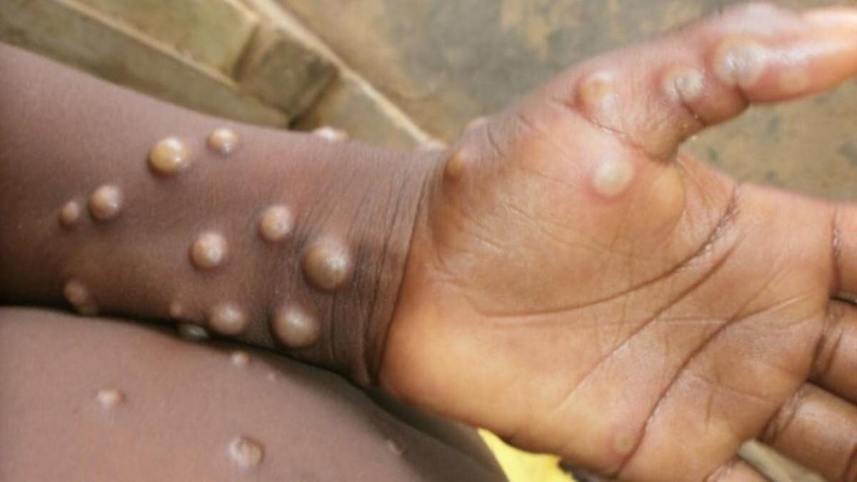 Monkeypox: यूपी सरकार ने मंकीपॉक्स को लेकर जारी किया अलर्ट, राजकीय मेडिकल कॉलेज में बनेगा अलग वार्ड - monkeypox alert issued by yogi government in uttar pradesh ntc - AajTak