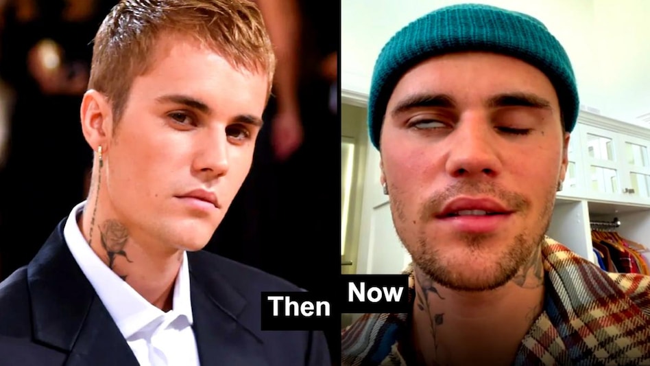 Justin bieber facial paralysis: आंखें भी नहीं झपका पा रहे जस्टिन बीबर! गंभीर बीमारी के लक्षण ना करें अनदेखा - Justin Bieber diagnosed with Ramsay Hunt Syndrome which causes facial paralysis RHS