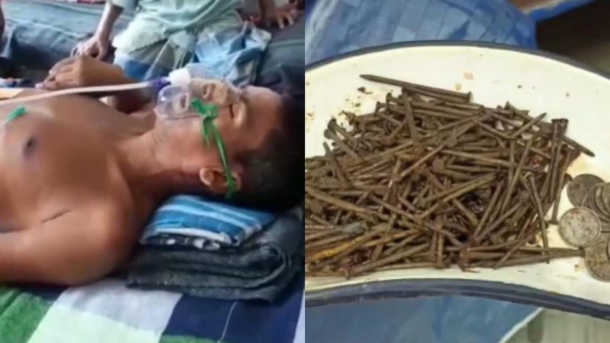 वर्धमान में शख्स के पेट से निकली कीलें