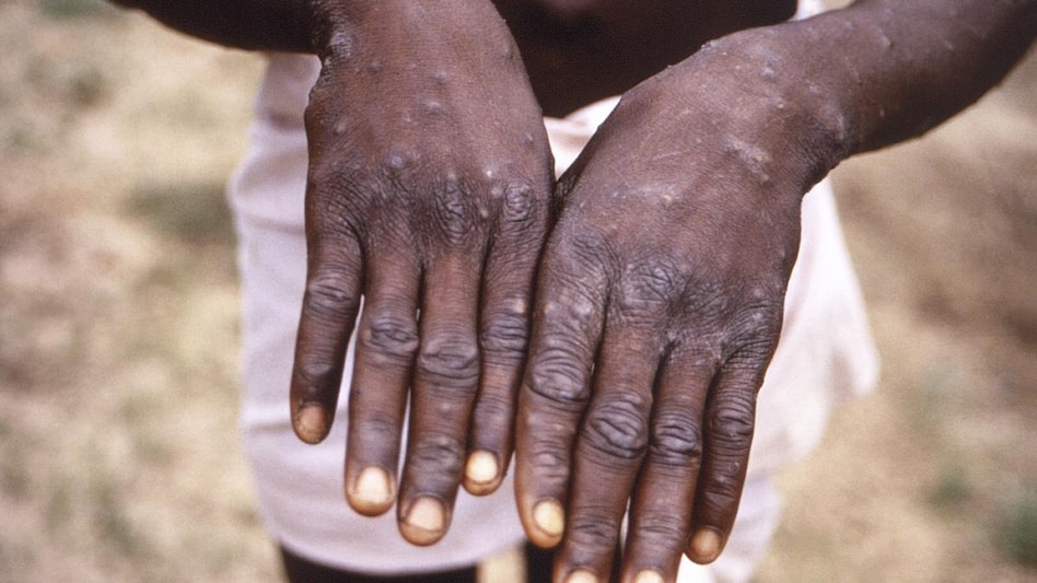 Monkeypox: इन 5 में से एक भी लक्षण दिखे तो हो जाएं सतर्क, टेस्टिंग-इलाज कहां होगा? सवाल-जवाब - monkeypox in india explainer monkeypox symptoms treatmen testing lngp hospital ntc - AajTak