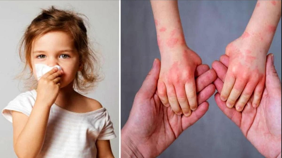 Tomato Flu से हो जाएं सावधान...केंद्र ने जारी की गाइडलाइन, इलाज-लक्षण सब बताया - Tomato Flu government guidelines symptoms ntc - AajTak