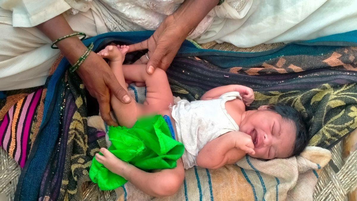 शामली में 3 पैरों वाले बच्चे ने लिया जन्म. 