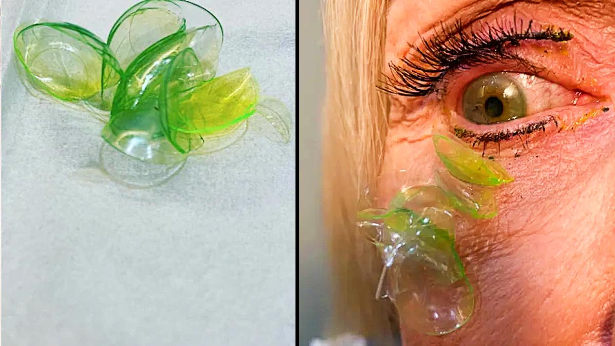 महिला की आंख से निकाले 23 कॉन्ट्रैक्ट लैंस (Image credit: Dr. Katerina Kurteeva)