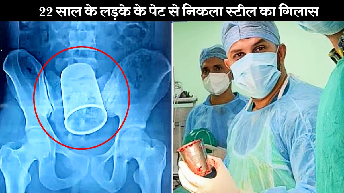 लड़के का एक्स-रे और उसके पेट से निकला हुआ गिलास. (Image credit: Aarti Verma)