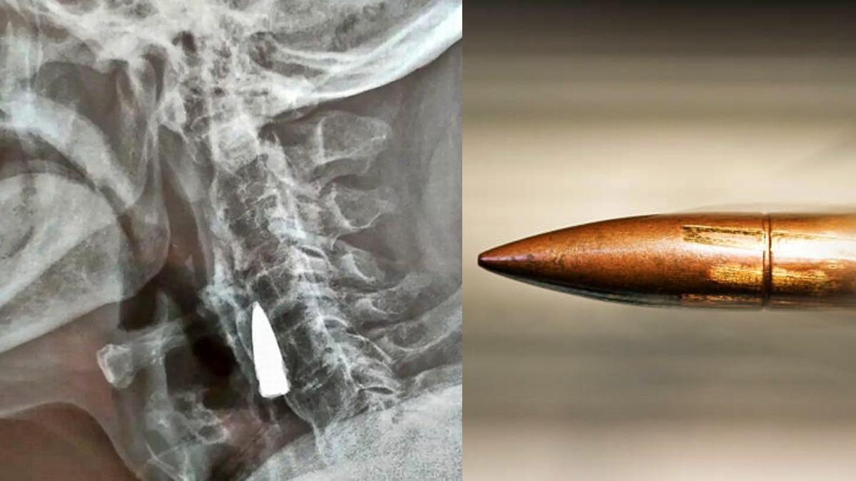 77 साल से बुजुर्ग के गले में फंसी थी गोली 