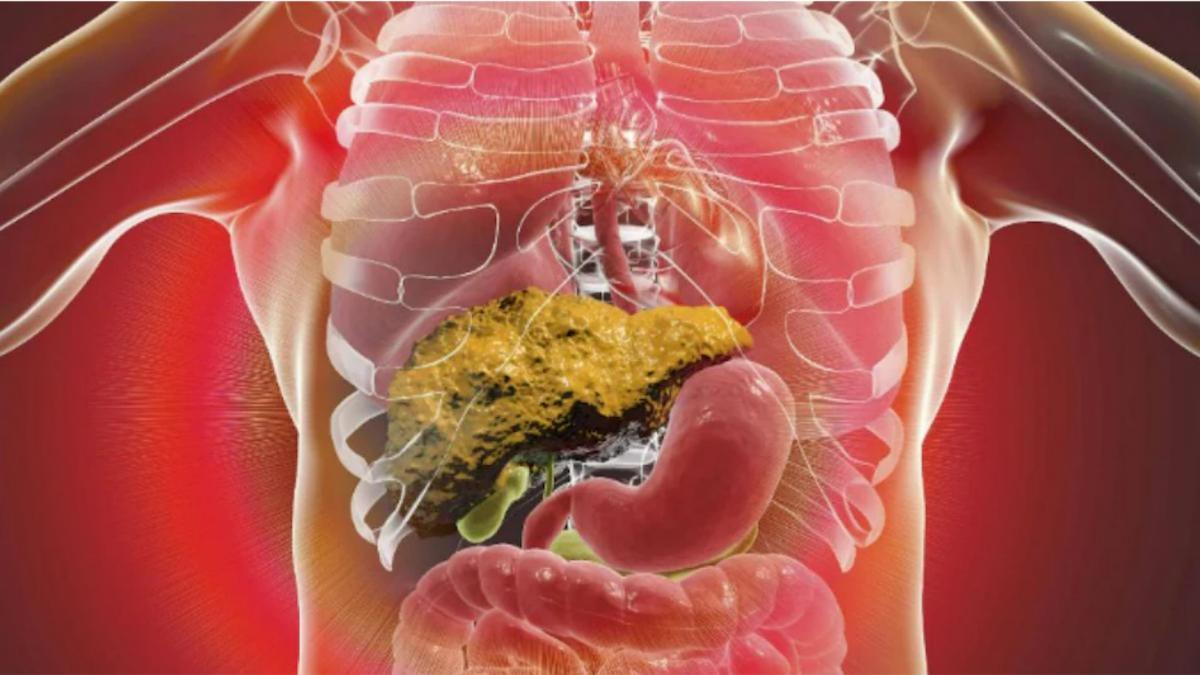 एल्कोहॉलिक फैटी लिवर (PC: Getty Images)