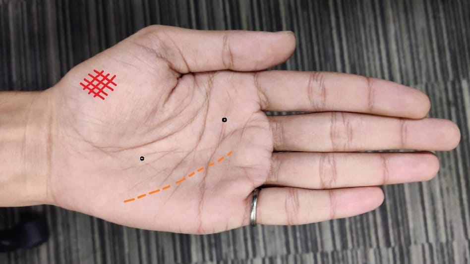 Shramveerbhatat news Jabalpur Madhya Pradesh January 4, 2023 हथेली पर ये 5 निशान देते हैं बर्बादी का संकेत, कहीं आपके हाथ पर तो नहीं? ऐसा कहते हैं कि इंसान की हथेली पर मौजूद ये लकी निशान निर्धन को भी धनवान बना सकते हैं. लेकिन क्या जानते हैं कि लकी निशान की तरह हथेली पर अनलकी निशान भी होते हैं. हथेली के रेखाओं में कैद ये अशुभ निशान किसी को भी बर्बादी की कगार पर धकेल सकते हैं. हथेली पर ये 5 निशान देते हैं बर्बादी का संकेत, कहीं आपके हाथ पर तो नहीं? Unlucky Signs On Palm: हथेली पर लकी साइन या शुभ निशानों के बारे में तो आपने जरूर सुना होगा. ऐसा कहते हैं कि इंसान की हथेली पर मौजूद ये लकी निशान निर्धन को भी धनवान बना सकते हैं. लेकिन क्या जानते हैं कि लकी निशान की तरह हथेली पर अनलकी निशान भी होते हैं. हथेली की रेखाओं में कैद ये अशुभ निशान किसी को भी बर्बादी की कगार पर धकेल सकते हैं. आइए आज आपको हथेली पर ऐसे 5 अशुभ निशानों के बारे में बताते हैं. मुख्य रेखाओं का टूटना हस्तरेखा शास्त्र के अनुसार, हथेली में तीन मुख्य रेखाएं होती हैं- हृदय रेखा, जीवन रेखा और मस्तिष्क रेखा. इन रेखाओं का बीच में ब्रेक होना या टूटना बहुत अशुभ समझा जाता है. उदाहण के तौर पर अगर किसी इंसान की जीवन रेखा टूटी हुई है तो उसके दांपत्य जीवन में बहुत सी परेशानियां आती हैं. लोगों के तलाक भी हो जाते हैं. इसी तरह, अगर हथेली पर जीवन रेखा टूटी हो तो दुर्घटना, खतरा, आपदा और बीमारियों की संभावना बनती हैं. हथेली पर चेन स्ट्रक्चर हथेली पर चेन का निशान एक दूसरे के साथ जुड़े छोटे-छोटे आईलैंड की सीरीज को दर्शाता है. चेन का ये निशान हमेशा अशुभ परिणाम ही देता है, फिर चाहे ये किसी भी रेखा पर हो. ये निशान जीवन में कुछ बुरा होने की संकेत देता है. उदाहरण के लिए आपका जन्म खराब स्वास्थ्य के साथ हो सकता है. आपको डाइजेशन से जुड़ी समस्या हो सकती है. यदि यह चेन भाग्य रेखा पर हो तो इंसान को मस्तिष्क से संबंधित समस्याएं रहती हैं. Air India की फ्लाइट में बुजुर्ग महिला से गंदी हरकत, नशे में धुत शख्स ने कपड़ों पर की पेशाब, फिर भी बचकर निकल गया हाथ पर ग्रिल हथेली पर जब छोटी-छोटी रेखाएं एक दूसरे को काटकर जाल जैसा निशान बनाती हैं तो इसे ग्रिल कहा जाता है. यह ग्रिल अशुभ, नकारात्मकता और समस्याओं की तरफ इशारा करती है. उदाहण के लिए अगर यह ग्रिल हेथली में बुध पर्वत पर बने तो शादी-विवाह के दौरान बड़े-उतार चढ़ाव देखने पड़ते हैं. असामान्य यौन संबंध भी आपको परेशान कर सकता है. हथेली पर ये निशान हो तो लोगों को बड़ी मुश्किल से अच्छा लाइफ पार्टनर मिलता है और मिडिल एज में शादी टूटने की संभावनाएं अधिक हो जाती हैं. हथेली पर डॉट या स्पॉट हथेली पर डॉट या स्पॉट एक तरह के फुल स्टॉप होते हैं जो आपके एनर्जी फ्लो में गड़बड़ी को दर्शाते हैं. आमतौर पर इन्हें संकट, गंभीर बीमारी या दुर्घटनाओं से जोड़कर देखा जाता है. उदाहरण के लिए अगर किसी इंसान की जीवन रेखा पर डॉट या स्पॉट हो तो वो बीमारी और मृत्यु को दर्शाता है. अगर ये धब्बे हृदय रेखा पर हों तो जीवन में इमोशनल क्राइसिस (भावनात्मक संकट) की स्थिति बनती है. सिमियन लाइन भाग्य रेखा और हृदय रेखा को ओवरलैप करने वाली रेखा को सिमियन लाइन कहा जाता है. महिलाओं के लिए इस रेखा को बहुत अशुभ समझा जाता है. ऐसा कहते हैं कि जिन महिलाओं की हथेली पर सिमियन लाइन होती है, उन्हें जीवन में संघर्ष, दुर्भाग्य और पार्टनर से तलाक मिलने का खतरा रहता है. Shramveerbhatat news Jabalpur Madhya Pradesh
January 4, 2023
हथेली पर ये 5 निशान देते हैं बर्बादी का संकेत, कहीं आपके हाथ पर तो नहीं?
ऐसा कहते हैं कि इंसान की हथेली पर मौजूद ये लकी निशान निर्धन को भी धनवान बना सकते हैं. लेकिन क्या जानते हैं कि लकी निशान की तरह हथेली पर अनलकी निशान भी होते हैं. हथेली के रेखाओं में कैद ये अशुभ निशान किसी को भी बर्बादी की कगार पर धकेल सकते हैं.
हथेली पर ये 5 निशान देते हैं बर्बादी का संकेत, कहीं आपके हाथ पर तो नहीं?
Unlucky Signs On Palm: हथेली पर लकी साइन या शुभ निशानों के बारे में तो आपने जरूर सुना होगा. ऐसा कहते हैं कि इंसान की हथेली पर मौजूद ये लकी निशान निर्धन को भी धनवान बना सकते हैं. लेकिन क्या जानते हैं कि लकी निशान की तरह हथेली पर अनलकी निशान भी होते हैं. हथेली की रेखाओं में कैद ये अशुभ निशान किसी को भी बर्बादी की कगार पर धकेल सकते हैं. आइए आज आपको हथेली पर ऐसे 5 अशुभ निशानों के बारे में बताते हैं.
मुख्य रेखाओं का टूटना
हस्तरेखा शास्त्र के अनुसार, हथेली में तीन मुख्य रेखाएं होती हैं- हृदय रेखा, जीवन रेखा और मस्तिष्क रेखा. इन रेखाओं का बीच में ब्रेक होना या टूटना बहुत अशुभ समझा जाता है. उदाहण के तौर पर अगर किसी इंसान की जीवन रेखा टूटी हुई है तो उसके दांपत्य जीवन में बहुत सी परेशानियां आती हैं. लोगों के तलाक भी हो जाते हैं. इसी तरह, अगर हथेली पर जीवन रेखा टूटी हो तो दुर्घटना, खतरा, आपदा और बीमारियों की संभावना बनती हैं.
हथेली पर चेन स्ट्रक्चर
हथेली पर चेन का निशान एक दूसरे के साथ जुड़े छोटे-छोटे आईलैंड की सीरीज को दर्शाता है. चेन का ये निशान हमेशा अशुभ परिणाम ही देता है, फिर चाहे ये किसी भी रेखा पर हो. ये निशान जीवन में कुछ बुरा होने की संकेत देता है. उदाहरण के लिए आपका जन्म खराब स्वास्थ्य के साथ हो सकता है. आपको डाइजेशन से जुड़ी समस्या हो सकती है. यदि यह चेन भाग्य रेखा पर हो तो इंसान को मस्तिष्क से संबंधित समस्याएं रहती हैं.
Air India की फ्लाइट में बुजुर्ग महिला से गंदी हरकत, नशे में धुत शख्स ने कपड़ों पर की पेशाब, फिर भी बचकर निकल गया
हाथ पर ग्रिल
हथेली पर जब छोटी-छोटी रेखाएं एक दूसरे को काटकर जाल जैसा निशान बनाती हैं तो इसे ग्रिल कहा जाता है. यह ग्रिल अशुभ, नकारात्मकता और समस्याओं की तरफ इशारा करती है. उदाहण के लिए अगर यह ग्रिल हेथली में बुध पर्वत पर बने तो शादी-विवाह के दौरान बड़े-उतार चढ़ाव देखने पड़ते हैं. असामान्य यौन संबंध भी आपको परेशान कर सकता है. हथेली पर ये निशान हो तो लोगों को बड़ी मुश्किल से अच्छा लाइफ पार्टनर मिलता है और मिडिल एज में शादी टूटने की संभावनाएं अधिक हो जाती हैं.
हथेली पर डॉट या स्पॉट
हथेली पर डॉट या स्पॉट एक तरह के फुल स्टॉप होते हैं जो आपके एनर्जी फ्लो में गड़बड़ी को दर्शाते हैं. आमतौर पर इन्हें संकट, गंभीर बीमारी या दुर्घटनाओं से जोड़कर देखा जाता है. उदाहरण के लिए अगर किसी इंसान की जीवन रेखा पर डॉट या स्पॉट हो तो वो बीमारी और मृत्यु को दर्शाता है. अगर ये धब्बे हृदय रेखा पर हों तो जीवन में इमोशनल क्राइसिस (भावनात्मक संकट) की स्थिति बनती है.
सिमियन लाइन
भाग्य रेखा और हृदय रेखा को ओवरलैप करने वाली रेखा को सिमियन लाइन कहा जाता है. महिलाओं के लिए इस रेखा को बहुत अशुभ समझा जाता है. ऐसा कहते हैं कि जिन महिलाओं की हथेली पर सिमियन लाइन होती है, उन्हें जीवन में संघर्ष, दुर्भाग्य और पार्टनर से तलाक मिलने का खतरा रहता है.