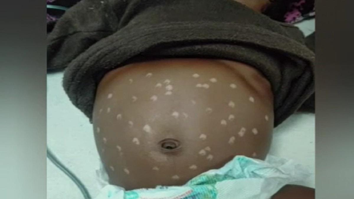 बच्ची को 51 बार गर्म सलाखों से दागा.