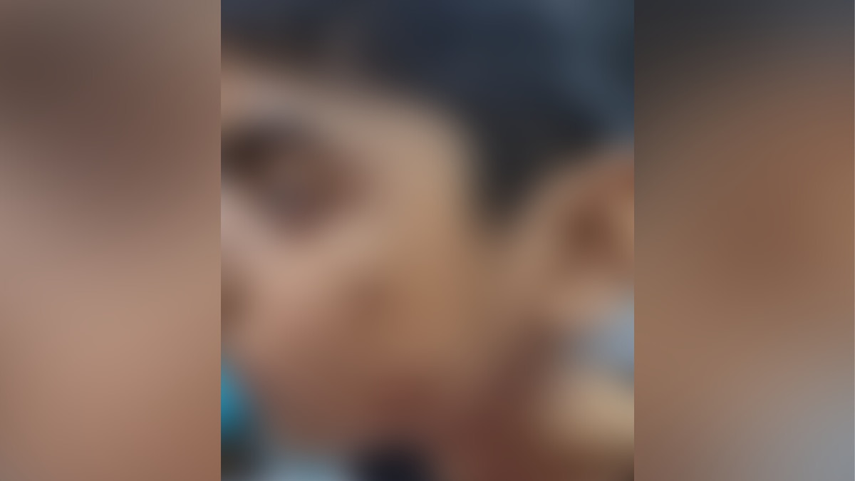 7 साल के मासूम को उसकी फुफेरी बहन ने सिगरेट से दाग दिया