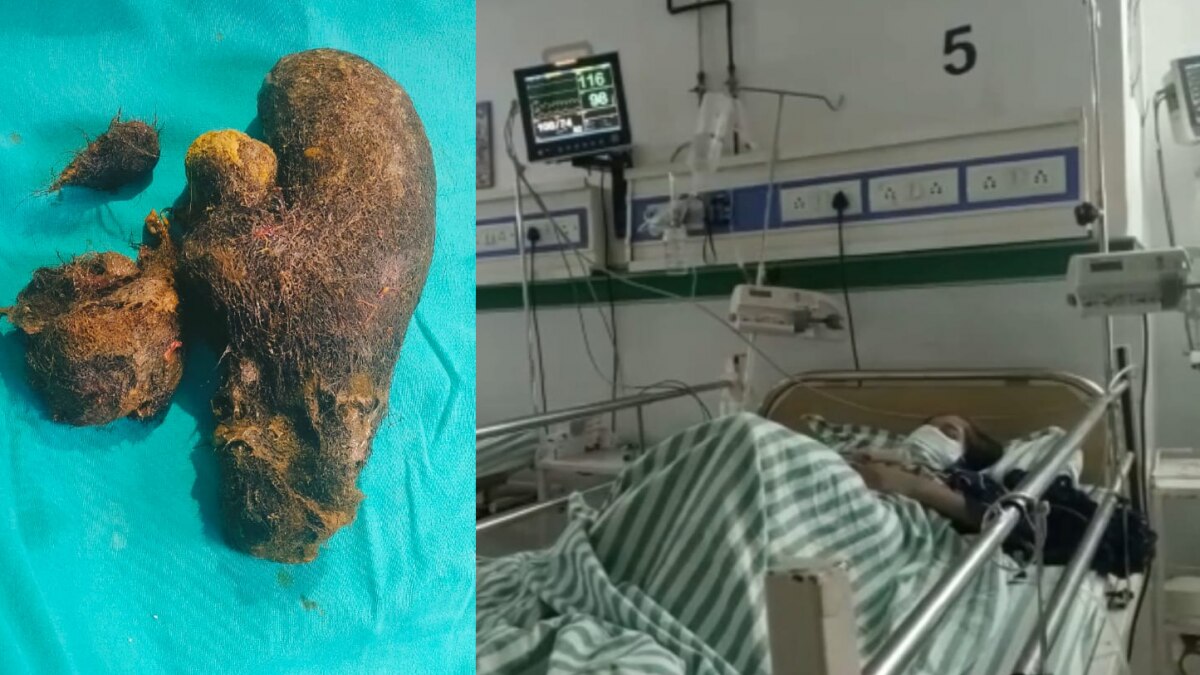 बच्ची को बाल खाने की आदत थी