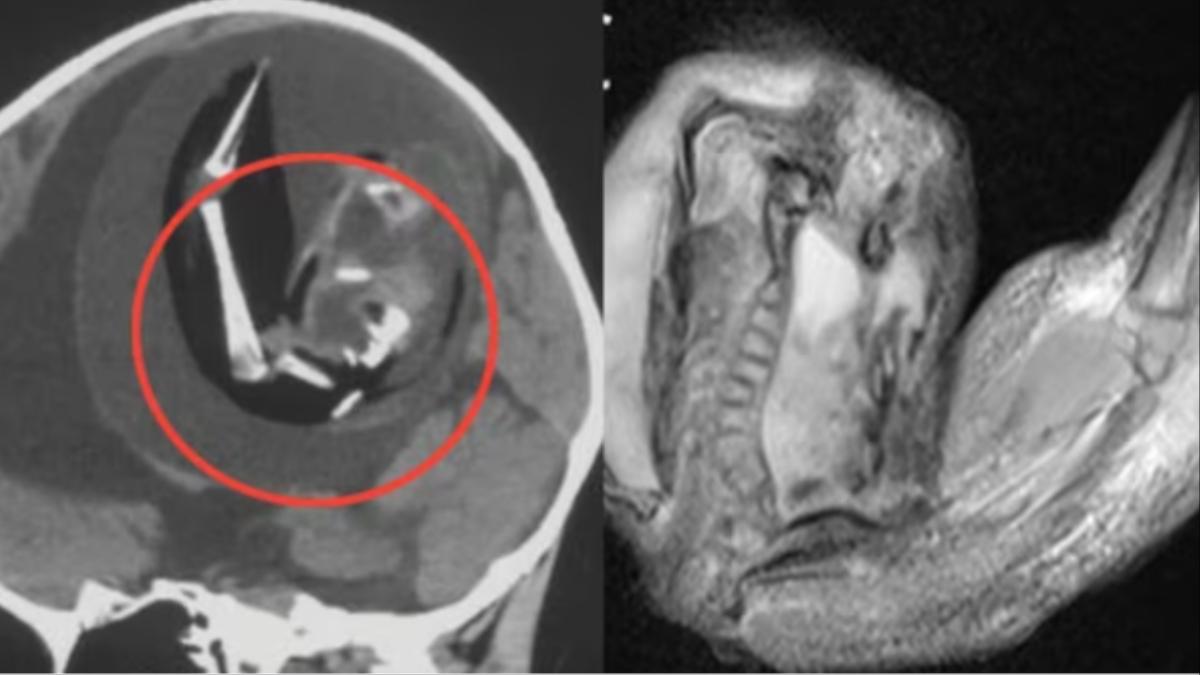 बच्ची के दिमाग में पाया गया अजन्मा भ्रूण