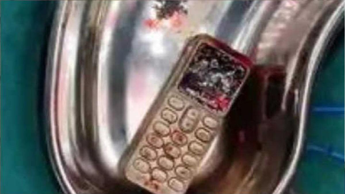 ऑपरेशन के बाद लड़की के पेट से निकला मोबाइल फोन.