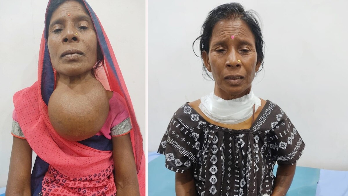 ऑपरेशन के पहले महिला और ऑपरेशन के बाद. 