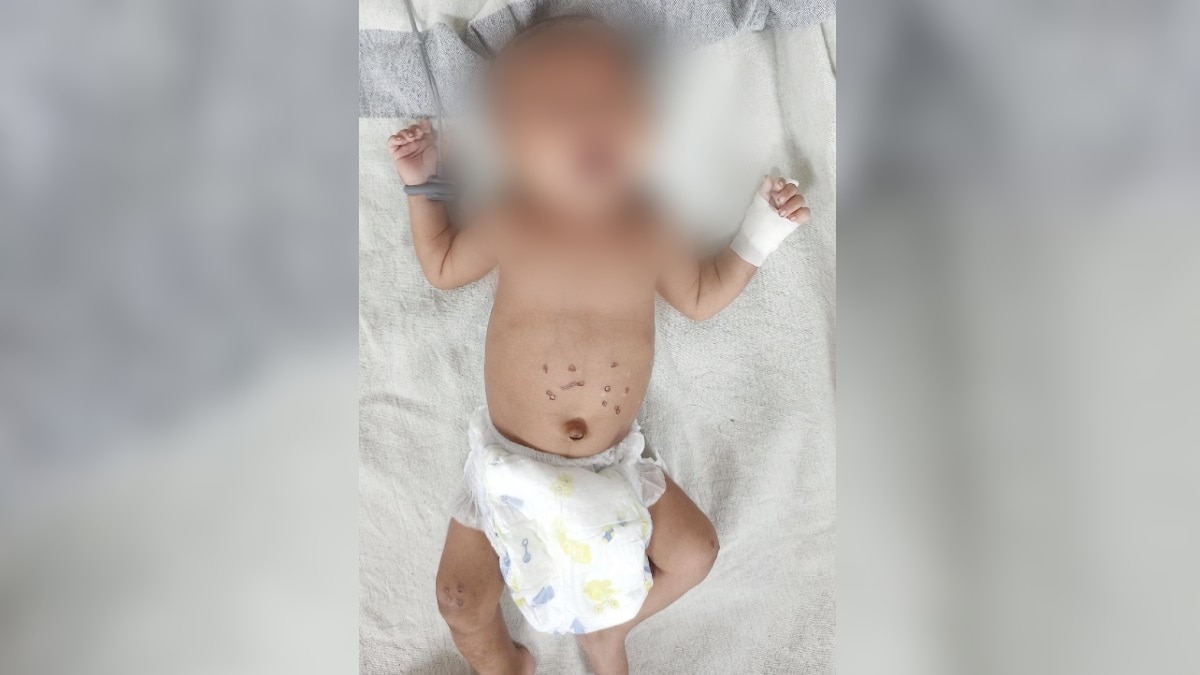 अस्पताल में भर्ती पीड़ित नवजात.  