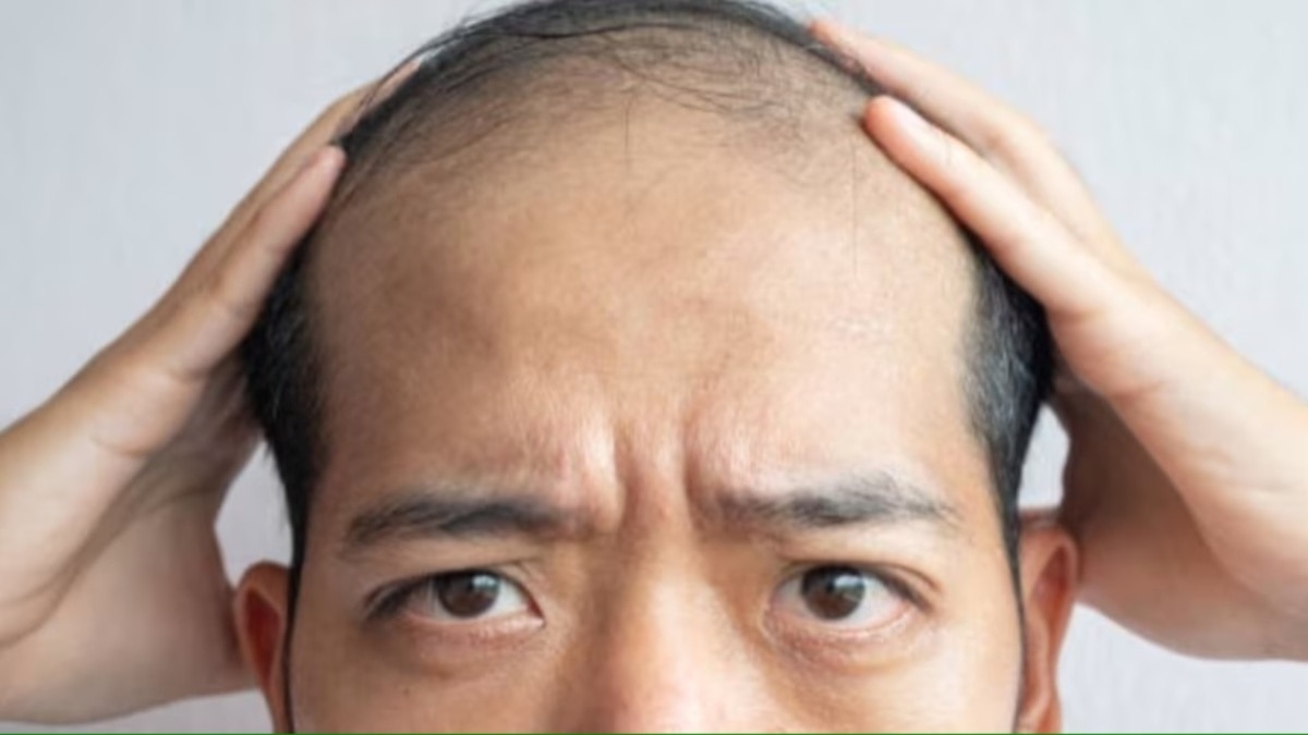 गंजी खोपड़ी पर कैसे बाल उगाएं, वैज्ञानिकों ने नई रिसर्च में बताया कारगर तरीका